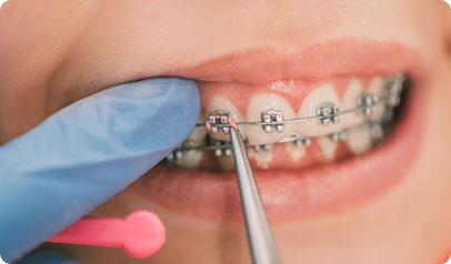 braces-aligners-img-3