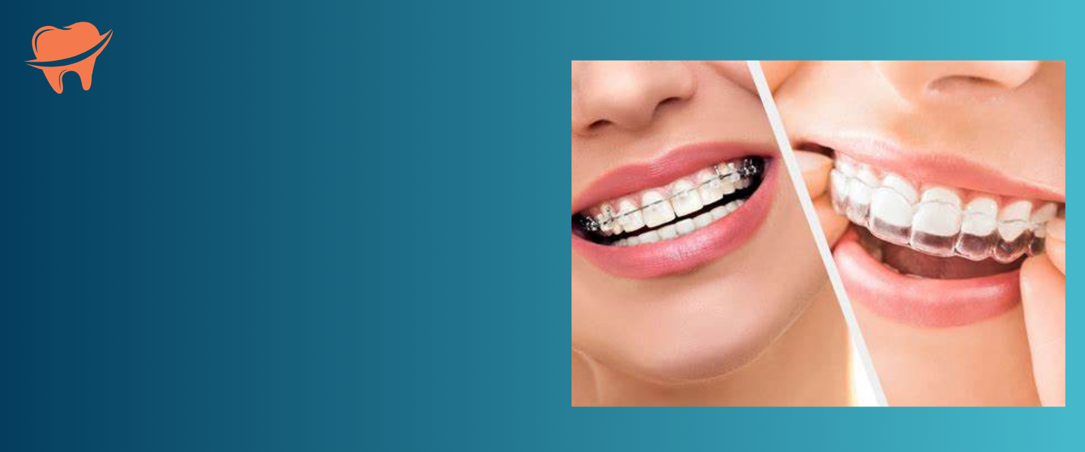 braces-aligners-image