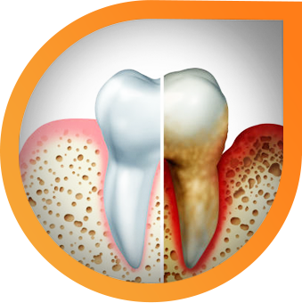 gum-disease-img-1