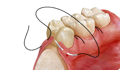 gum-disease-img-4