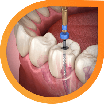 root-canal-img-1